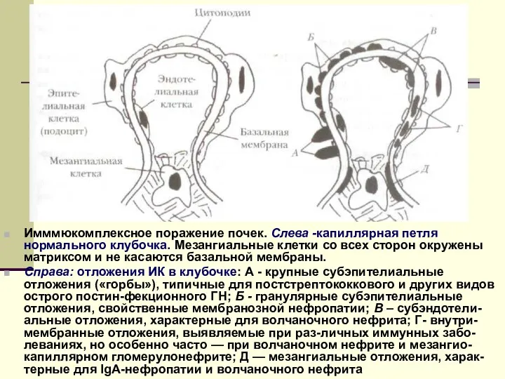 Имммюкомплексное поражение почек. Слева -капиллярная петля нормального клубочка. Мезангиальные клетки