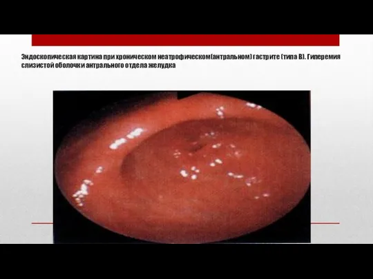 Эндоскопическая картина при хроническом неатрофическом(антральном) гастрите (типа В). Гиперемия слизистой оболочки антрального отдела желудка