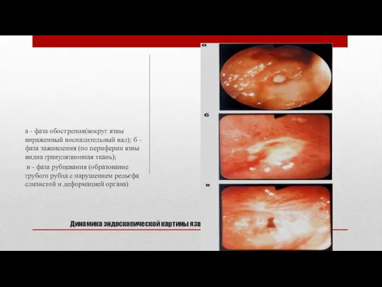 Динамика эндоскопической картины язвенной болезни желудка а - фаза обострения(вокруг