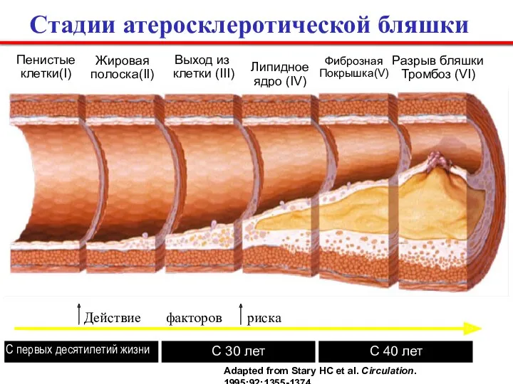 Cтадии атеросклеротической бляшки Пенистые клетки(I) Жировая полоска(II) Выход из клетки