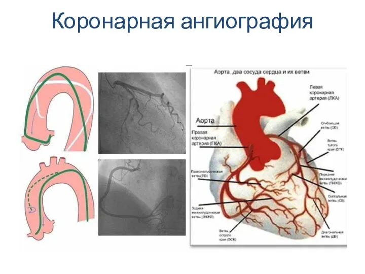 Коронарная ангиография