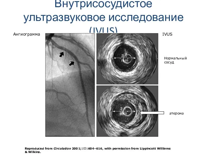 Внутрисосудистое ультразвуковое исследование (IVUS) Reproduced from Circulation 2001;103:604–616, with permission