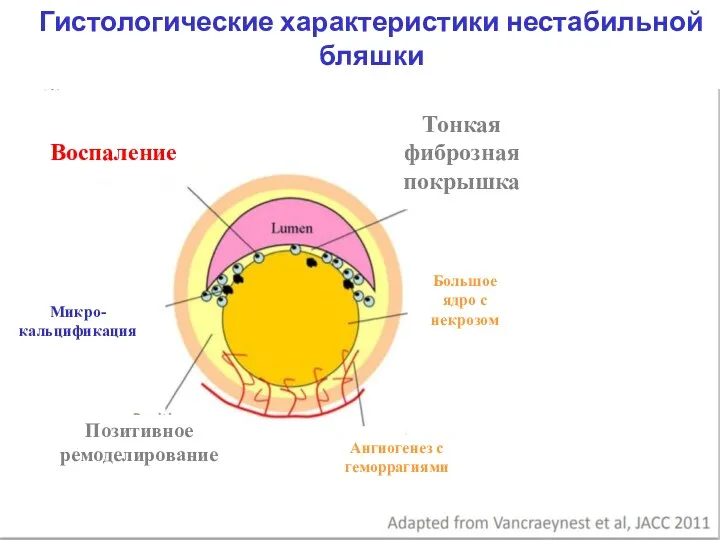 Гистологические характеристики нестабильной бляшки Воспаление Тонкая фиброзная покрышка Большое ядро