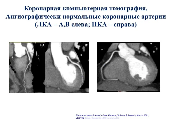 Коронарная компьютерная томография. Ангиографически нормальные коронарные артерии (ЛКА – А,В