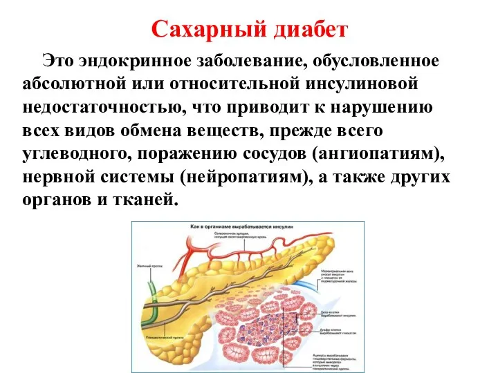 Сахарный диабет Это эндокринное заболевание, обусловленное абсолютной или относительной инсулиновой