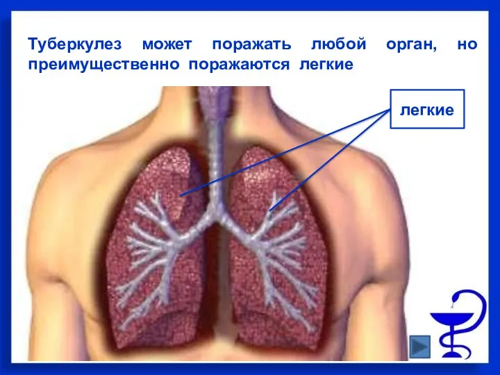 Туберкулез может поражать любой орган, но преимущественно поражаются легкие легкие