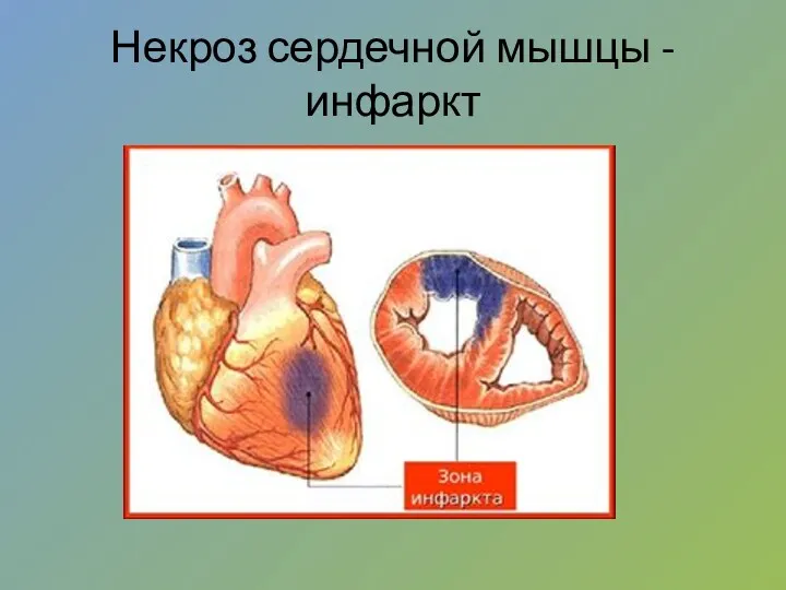 Некроз сердечной мышцы - инфаркт