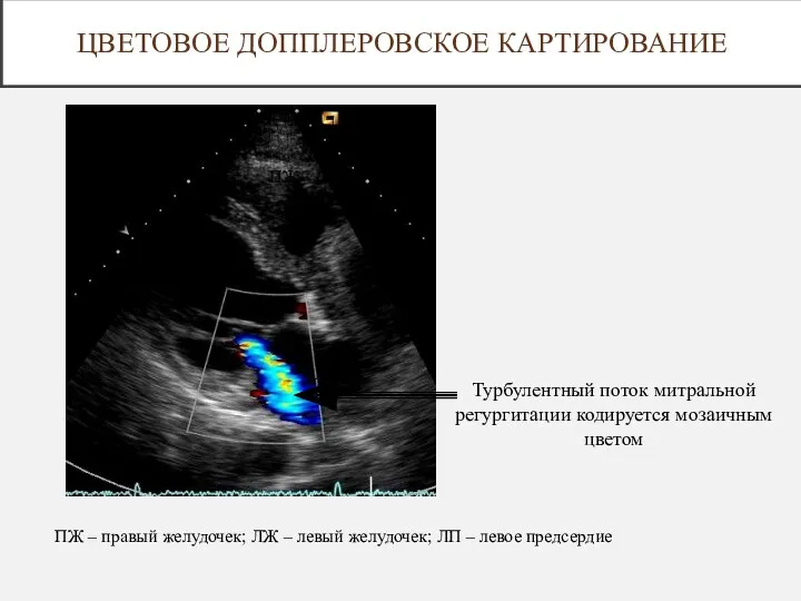 Турбулентный поток митральной регургитации кодируется мозаичным цветом ПЖ ЛЖ ЛП