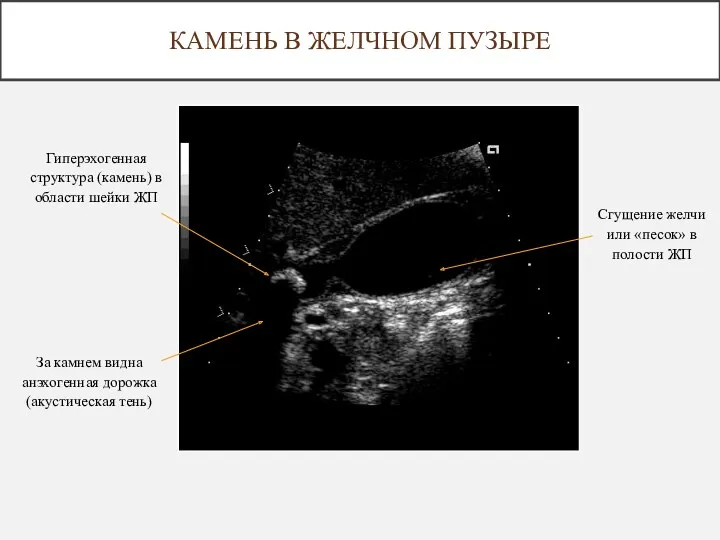 Гиперэхогенная структура (камень) в области шейки ЖП За камнем видна