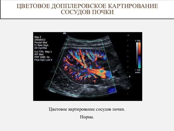 Цветовое картирование сосудов почки. Норма. ЦВЕТОВОЕ ДОППЛЕРОВСКОЕ КАРТИРОВАНИЕ СОСУДОВ ПОЧКИ