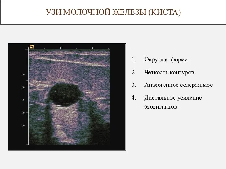 Округлая форма Четкость контуров Анэхогенное содержимое Дистальное усиление эхосигналов УЗИ МОЛОЧНОЙ ЖЕЛЕЗЫ (КИСТА)