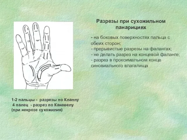 Разрезы при сухожильном панарициях - на боковых поверхностях пальца с