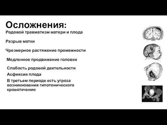 Осложнения Осложнения: Родовой травматизм матери и плода Разрыв матки Чрезмерное растяжение промежности Медленное