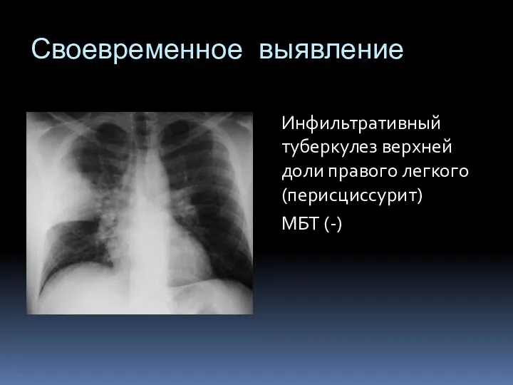 Своевременное выявление Инфильтративный туберкулез верхней доли правого легкого (перисциссурит) МБТ (-)