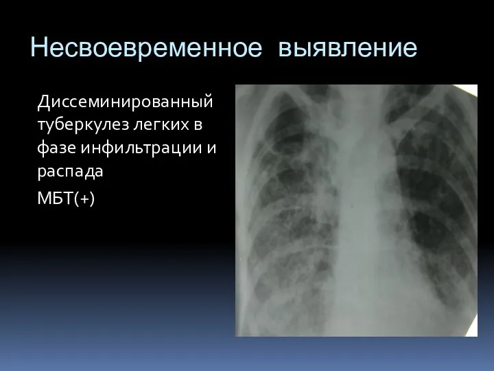 Несвоевременное выявление Диссеминированный туберкулез легких в фазе инфильтрации и распада МБТ(+)