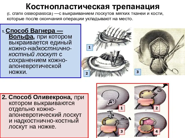 1. Способ Вагнера — Вольфа, при котором выкраивается единый кожно-надкостнично-костный