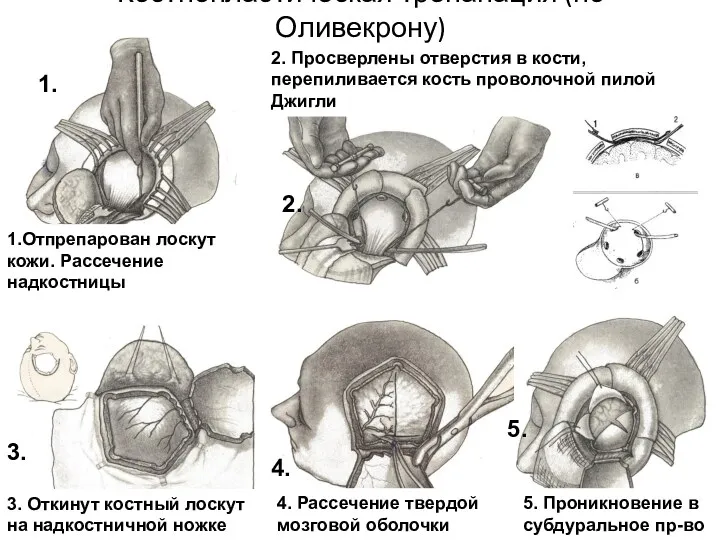 Костнопластическая трепанация (по Оливекрону) 1.Отпрепарован лоскут кожи. Рассечение надкостницы 2.