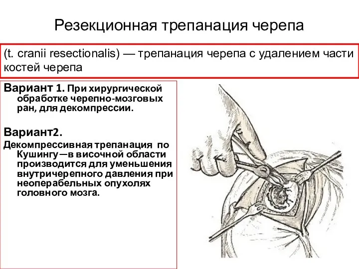 Резекционная трепанация черепа Вариант 1. При хирургической обработке черепно-мозговых ран,