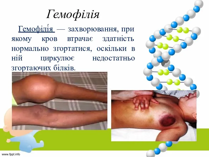 Гемофілія Гемофілі́я — захворювання, при якому кров втрачає здатність нормально