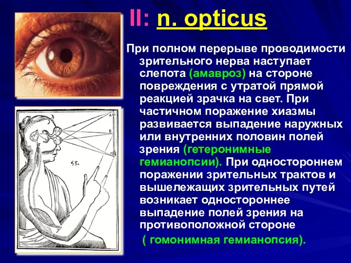 II: n. opticus При полном перерыве проводимости зрительного нерва наступает