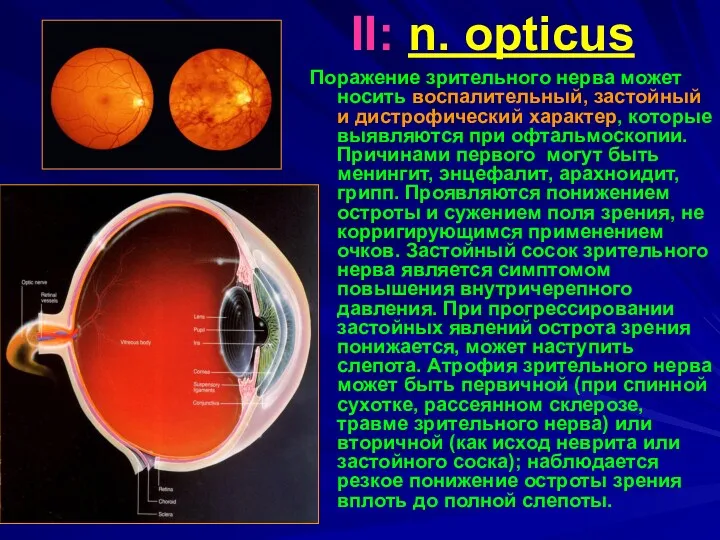 II: n. opticus Поражение зрительного нерва может носить воспалительный, застойный