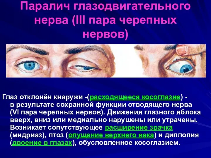 Паралич глазодвигательного нерва (III пара черепных нервов) Глаз отклонён кнаружи -(расходящееся косоглазие) -в