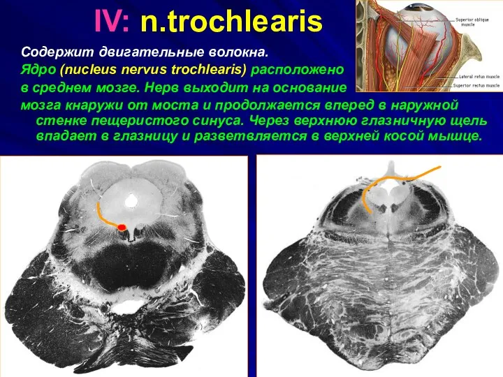 IV: n.trochlearis Содержит двигательные волокна. Ядро (nucleus nervus trochlearis) расположено в среднем мозге.