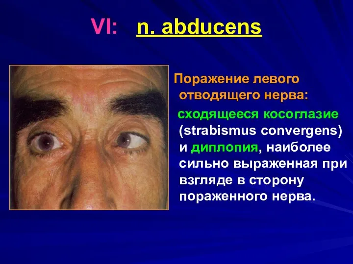 VI: n. abducens Поражение левого отводящего нерва: сходящееся косоглазие (strabismus
