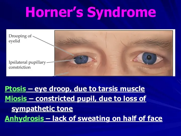 Horner’s Syndrome Ptosis – eye droop, due to tarsis muscle Miosis – constricted