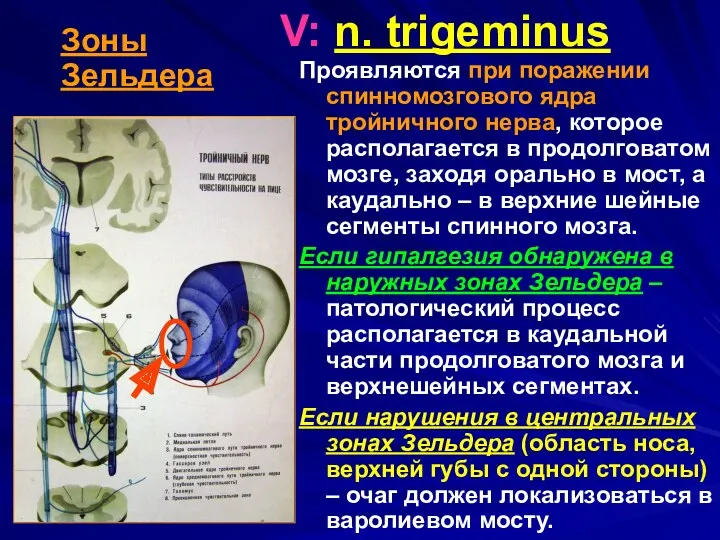 V: n. trigeminus Проявляются при поражении спинномозгового ядра тройничного нерва, которое располагается в