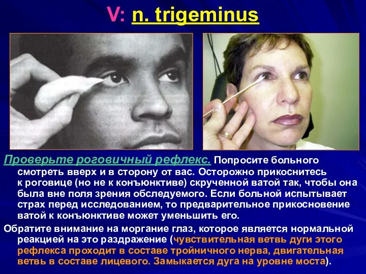 V: n. trigeminus Проверьте роговичный рефлекс. Попросите больного смотреть вверх и в сторону