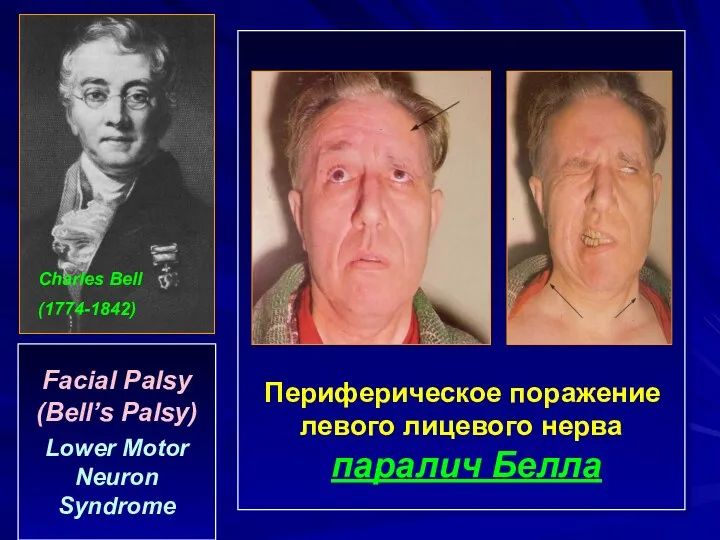 Facial Palsy (Bell’s Palsy) Lower Motor Neuron Syndrome Периферическое поражение левого лицевого нерва