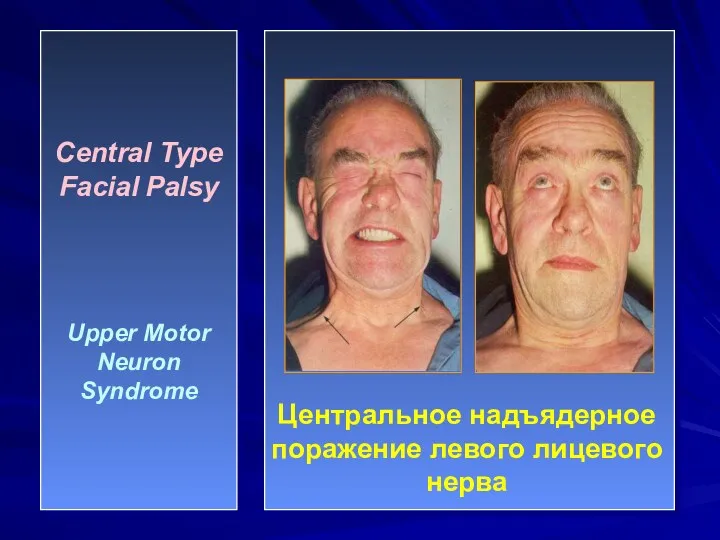 Central Type Facial Palsy Upper Motor Neuron Syndrome Центральное надъядерное поражение левого лицевого нерва