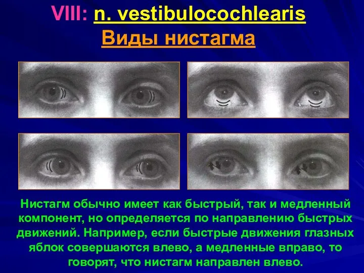 VIII: n. vestibulocochlearis Виды нистагма Нистагм обычно имеет как быстрый, так и медленный