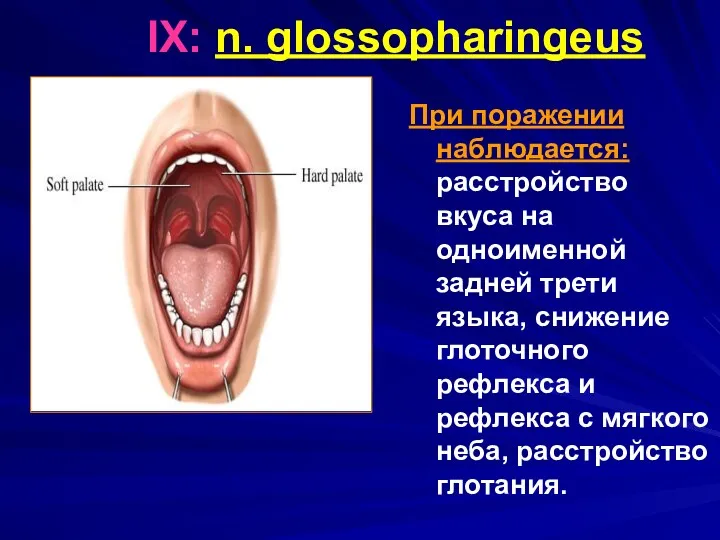 IX: n. glossopharingeus При поражении наблюдается: расстройство вкуса на одноименной