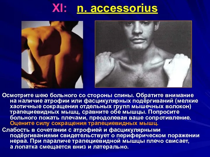 XI: n. accessorius Осмотрите шею больного со стороны спины. Обратите внимание на наличие