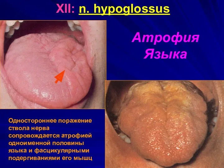 Атрофия Языка XII: n. hypoglossus Одностороннее поражение ствола нерва сопровождается атрофией одноименной половины
