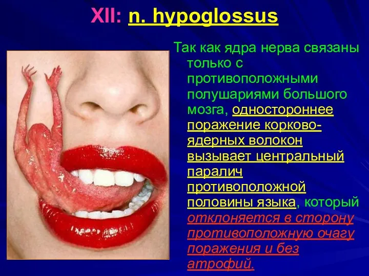 XII: n. hypoglossus Так как ядра нерва связаны только с противоположными полушариями большого