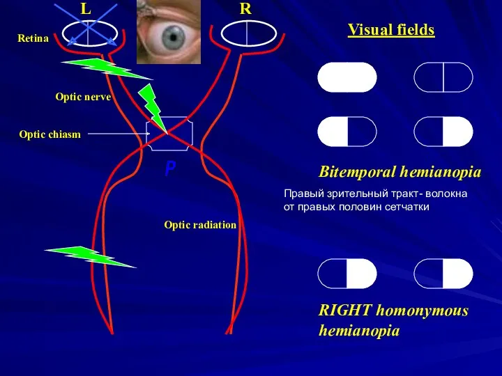 L R Visual fields Optic radiation Retina Optic nerve Optic chiasm Bitemporal hemianopia