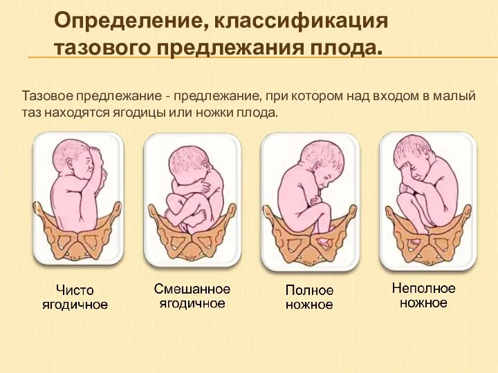 Определение, классификация тазового предлежания плода. Тазовое предлежание - предлежание, при