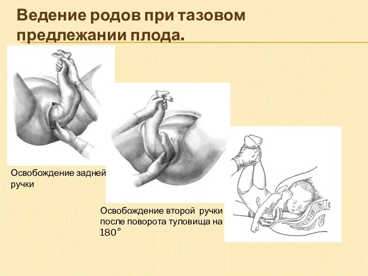 Ведение родов при тазовом предлежании плода. Освобождение задней ручки Освобождение