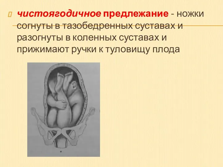 чистоягодичное предлежание - ножки согнуты в тазобедренных суставах и разогнуты