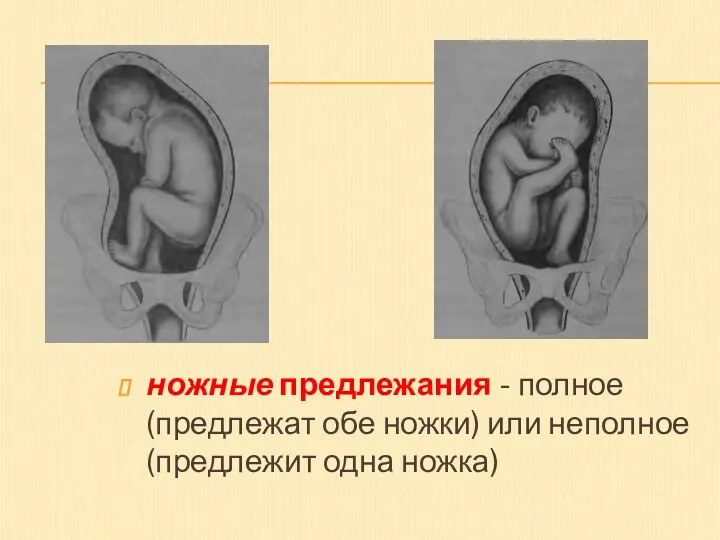 ножные предлежания - полное (предлежат обе ножки) или неполное (предлежит одна ножка)