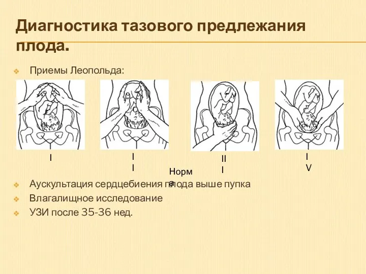 Диагностика тазового предлежания плода. Приемы Леопольда: Аускультация сердцебиения плода выше