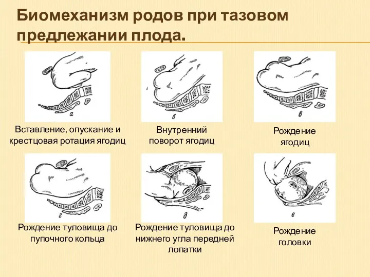 Биомеханизм родов при тазовом предлежании плода. Вставление, опускание и крестцовая