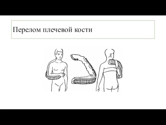 Перелом плечевой кости