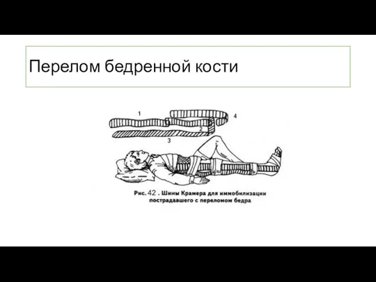 Перелом бедренной кости