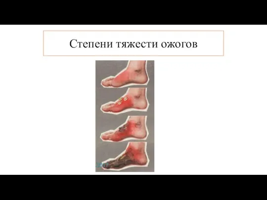 Степени тяжести ожогов