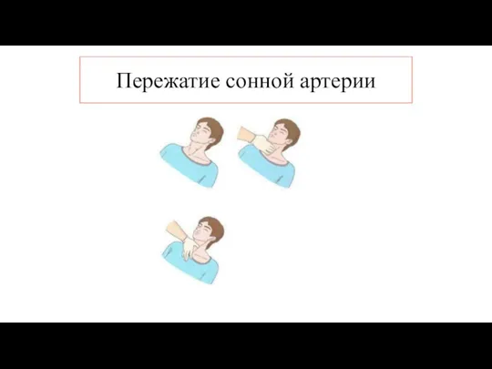 Пережатие сонной артерии