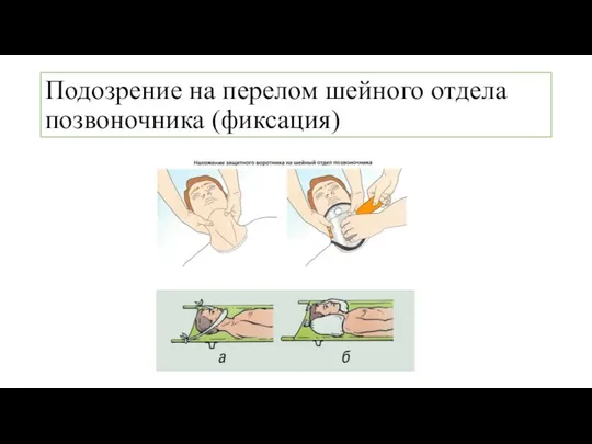 Подозрение на перелом шейного отдела позвоночника (фиксация)